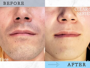 ラッシュ(RUSH)/10回でヒゲ脱毛完了!