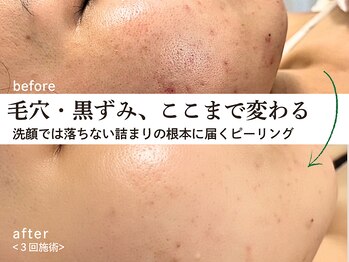ソレイユ(Soleil)の写真/毛穴・黒ずみここまで変わる|クレンジングや洗顔では落ちない"詰まりの根本"にアプローチするピーリング