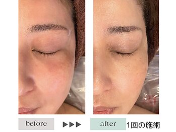 ハイケア グラン ギンザ(HYCARE GRAND GINZA)/日本ーの肌改善サロン実力/銀座