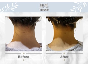セルフクリア(SELF CLEAR)/