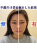 【驚愕小顔！！】美容顔ツボはりきゅうと肩首マッサージ　合計４０分