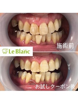 ルブラン 奈良店(Le Blanc)/詰め物や差し歯があってもOK