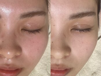 アルム(a'lm)/赤み・くすみ知らずの透明感☆