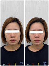 ラフテル鍼灸整骨院/たるみケアに美容鍼！