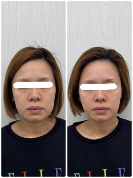 ラフテル鍼灸整骨院/たるみケアに美容鍼！