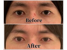 整体ラルース 中目黒(LALUZ)/20代　男性　二重整体　変化