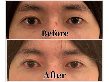 整体ラルース 中目黒(LALUZ)/20代 男性 二重整体 変化