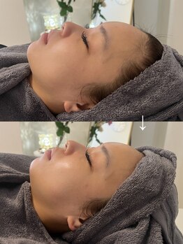 リリー(LILLY)/症例