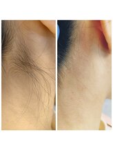 キアラ 麻布十番(Kiara)/うなじBeforeAfter