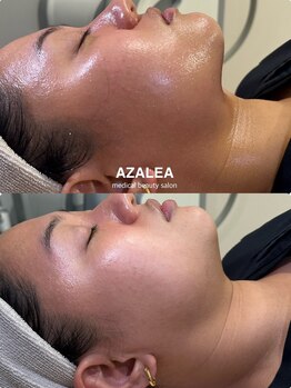 アザレア 新宿店(AZALEA)/マイクロウェーブリフト/新宿