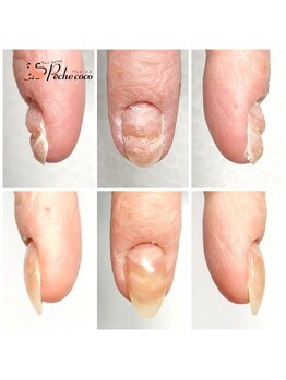 変形爪もお任せ下さい♪