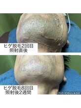 リバティー(Liberty)/ヒゲ脱毛