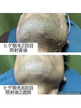 リバティー(Liberty)/ヒゲ脱毛