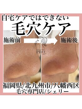 シェリー(Cherie)/毛穴の黒ずみはプロにお任せ！