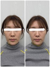 ラフテル鍼灸整骨院/結婚式前に小顔矯正×美容鍼♪