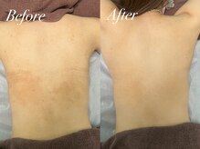 アンドナイン エス店(ANDNINE.)/美背中ハーブピーリング