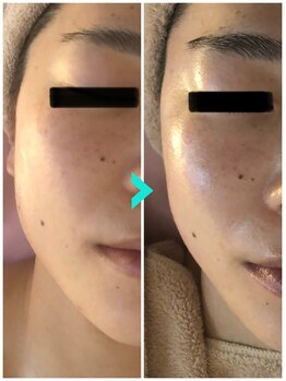 ミルキー(Milky)/食いしばりに小顔コルギ