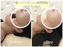 アキュモンド 渋谷院(acumond)/《たるみ二重顎改善》30代変化