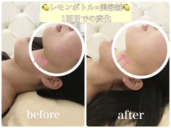 アキュモンド 渋谷院(acumond)/《たるみ二重顎改善》30代変化