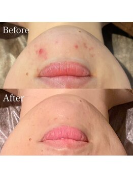 ゆりの花/ハーブピーリング