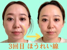 ナチュラルビューティーフェイス 横浜(NBF)/ほうれい線、タルミ/横浜市小顔