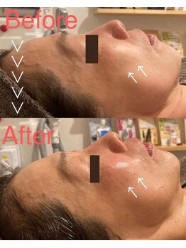 シェリー(CHERIE)の写真/年齢サインにサヨナラ！下がった顔も上向きに。効果的なリフトアップで自信を☆