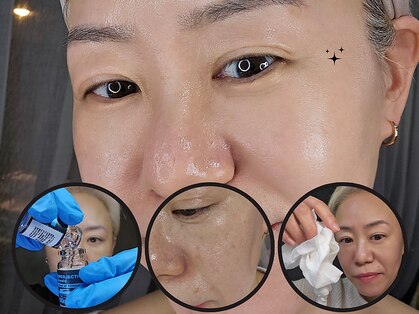 水光ピールスキン　池袋の写真