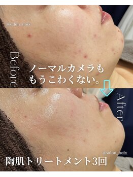 サロンノワ(salon noix)の写真/【島根・松江】肌悩み卒業！剥離なしハーブピーリングとオーダーメイド施術で、憧れのすっぴん美肌が叶う☆