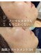 サロンノワ(salon noix)の写真/【島根・松江】肌悩み卒業！剥離なしハーブピーリングとオーダーメイド施術で、憧れのすっぴん美肌が叶う☆