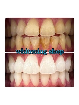 ホワイトニングショップ 所沢店/ホワイトニングショップ所沢店