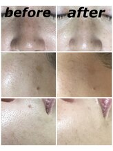 クリスタルボウ(Crystal BEAU)/カーボンピーリングフォト3回