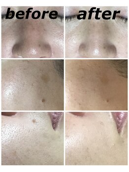 クリスタルボウ(Crystal BEAU)/カーボンピーリングフォト3回