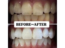 ホワイトニングサロン 豊中/Before&After美白ホワイトニング