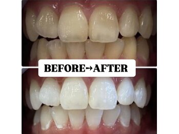 ホワイトニングサロン 豊中/Before&After美白ホワイトニング