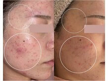 リファラ 光の森店(REFALA)/毛穴・ニキビケア専門REFALA