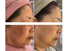 アンク(Ankh)/シミケアサロンの本気