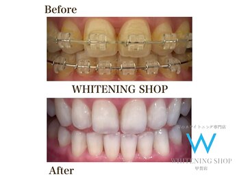 ホワイトニングショップ 甲賀店/Before&After『ホワイトニング』