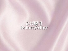 アブニールブリヨン/ハーブピーリング　Before After