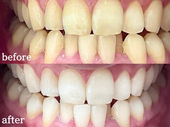 ピュアホワイトニング 横浜店/ホワイトニング/横浜/横浜駅