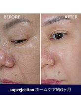 水光ピールスキン/ホームケア継続は大事