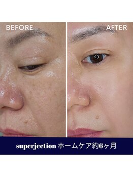 水光ピールスキン/ホームケア継続は大事