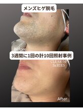 マウム(Maum)/青ヒゲ・朝の髭剃りの時間解消へ