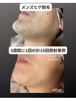 マウム(Maum)/青ヒゲ・朝の髭剃りの時間解消へ