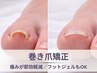 【2回目以降】歩くのが楽に♪爪のカーブを整える巻き爪矯正！指1本4,400円