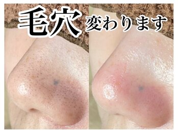 アンドピエル(AndPiel)/毛穴の黒ずみ撃退！