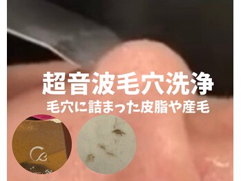 フォーチューン/超音波毛穴洗浄