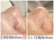 フルール(FLEUR)/ビオフィート/毛穴改善