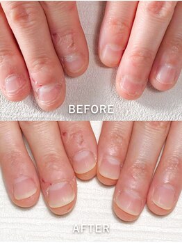 ポメロ(POMELO)/むしりたくなるササクレも除去