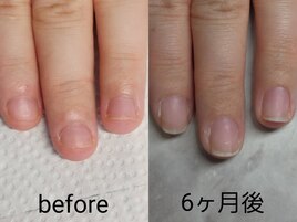 深爪矯正、やめるタイミング