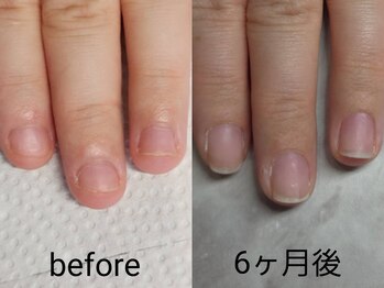 プリンセスネイル(Princess nail)/深爪矯正、やめるタイミング